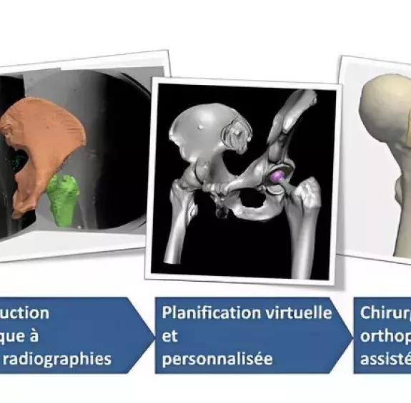 MyPlanner : une solution personnalisée pour l’arthroplastie totale basée sur la radiographie conventionnelle