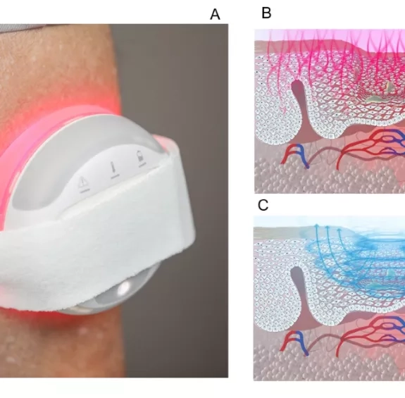 NAZARÉ : Stimulation optique et magnétique concomitante (COMS) pour le traitement des patients souffrant d&#039;ulcères chroniques d&#039;origine vasculaire dans un contexte réel incluant les soins à domicile